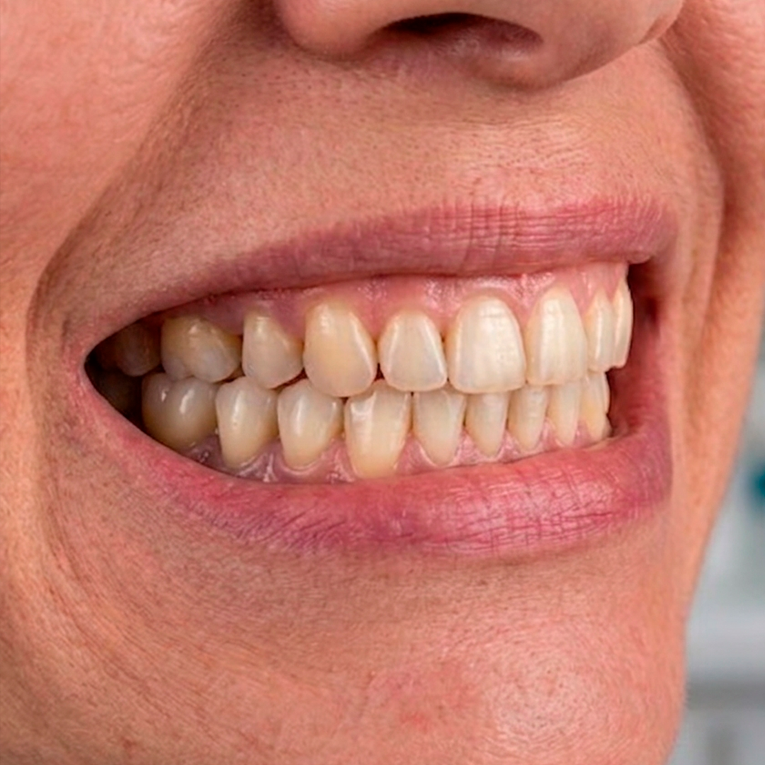 Depois da prótese fixa sobre implantes