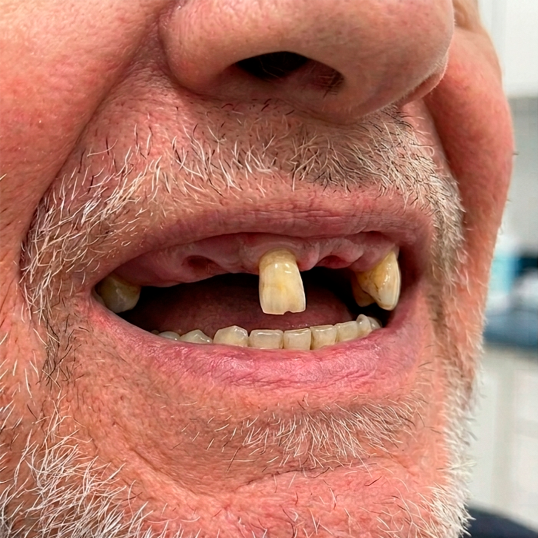 Antes do protocolo sobre implantes
