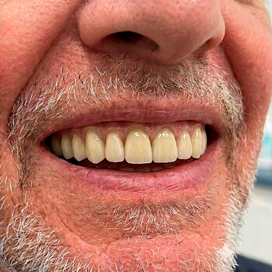 Depois do protocolo sobre implantes